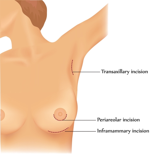 breast_augmentation_breast_implant_incision