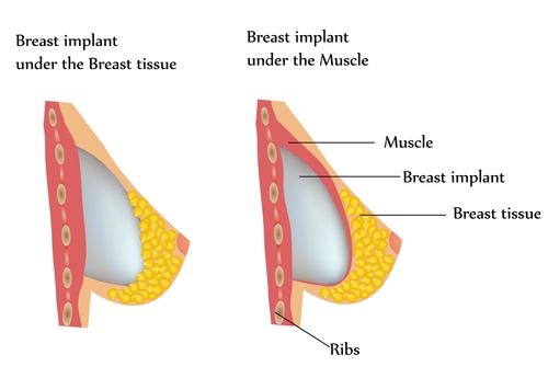 breast_augmentation_breast_implant_location