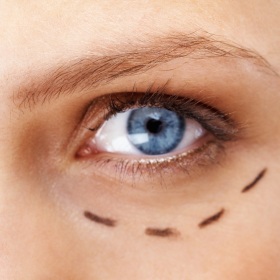 face_lift_cosmetic_eyelid_surgery_blepharoplasty_small